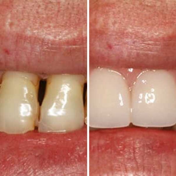 Custom denture — before and after — Case 7