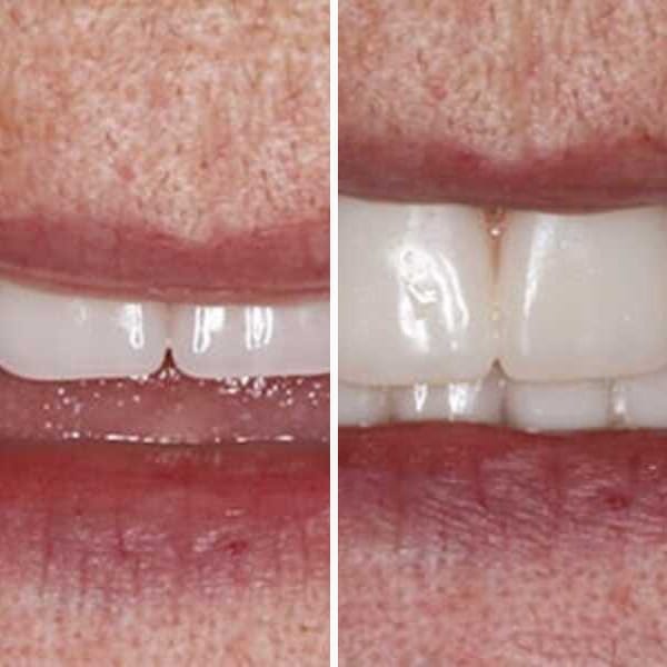 Custom denture — before and after — Case 8