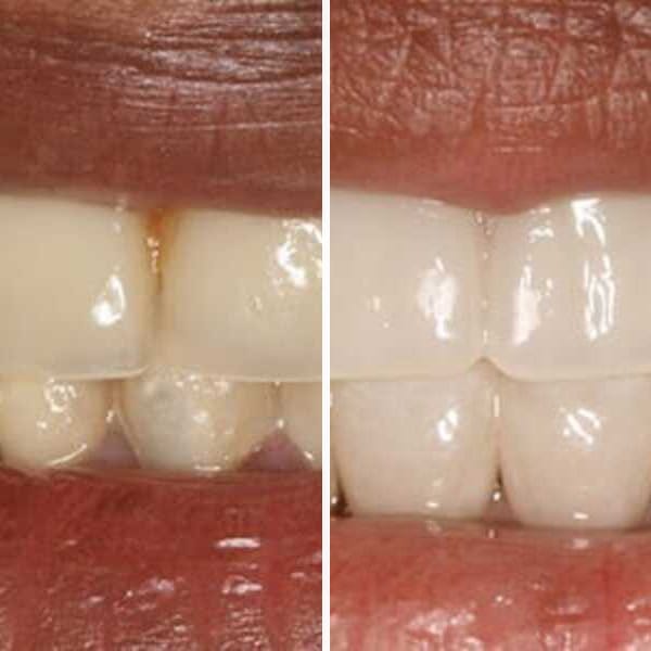 Custom denture — before and after — Case 9