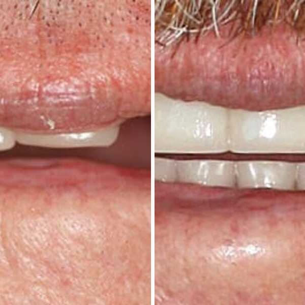 Dental implant — before, after, and X-ray — Case 1
