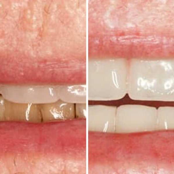 Dental implant — before, after, and X-ray — Case 2