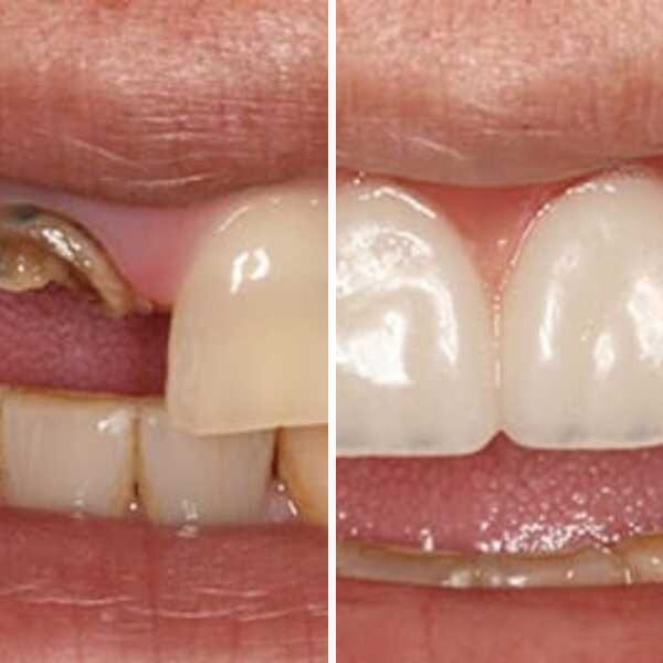 Dental implant — before, after, and X-ray — Case 3