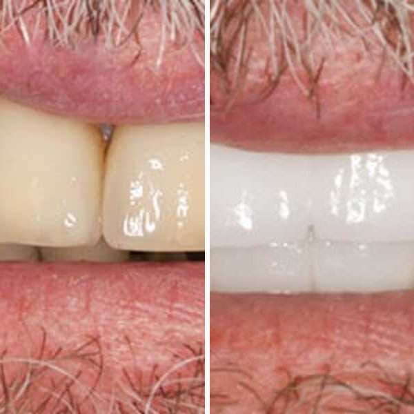 Dental implant — before, after, and X-ray — Case 4