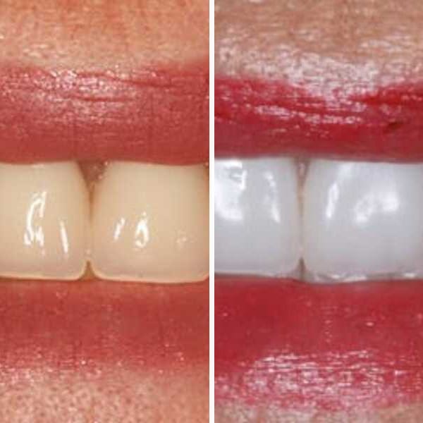 Dental implant — before, after, and X-ray — Case 5