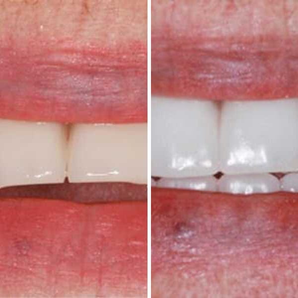 Dental implant — before, after, and X-ray — Case 6