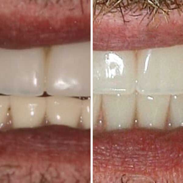 Dental implant — before, after, and X-ray — Case 7