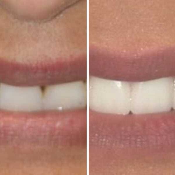 Implant-supported bridge — before and after — Case 1