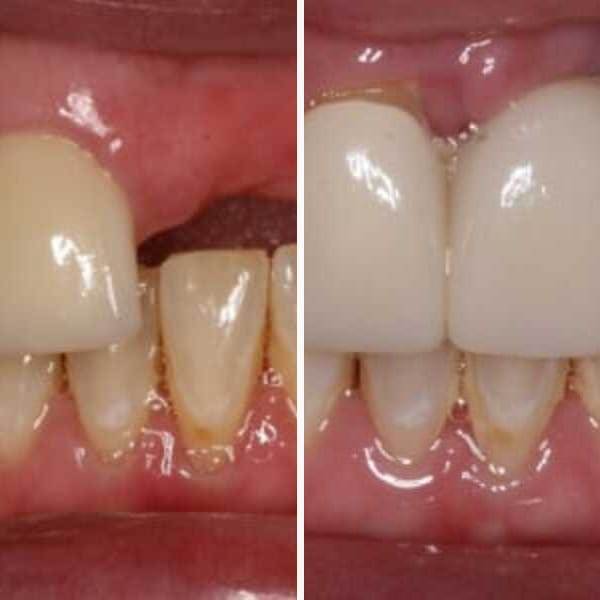 Implant-supported bridge — before and after — Case 2
