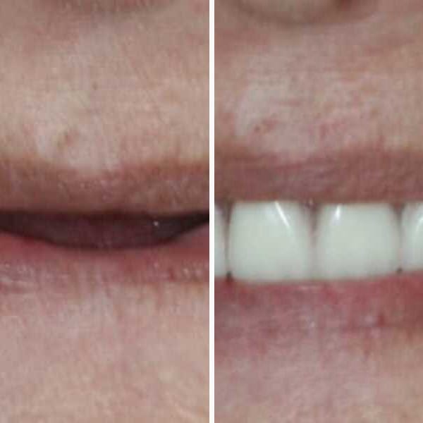 Implant-supported denture — before and after — Case 1