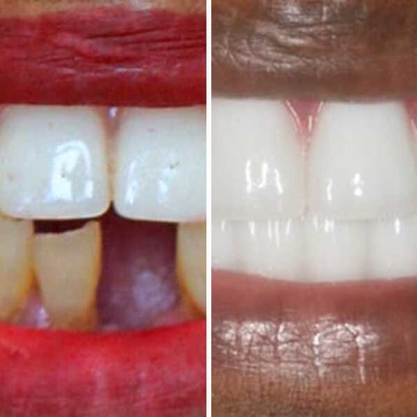 Implant-supported denture — before and after — Case 2