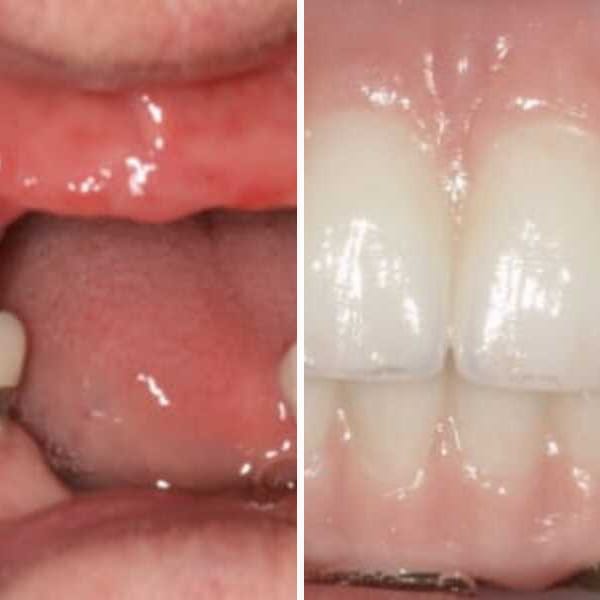 Implant-supported denture — before and after — Case 3
