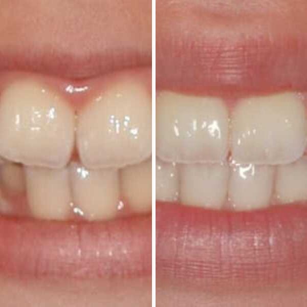 Pediatric orthodontic correction - Case 1