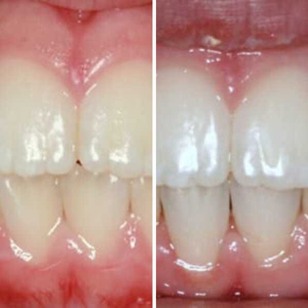 Pediatric orthodontic correction - Case 2