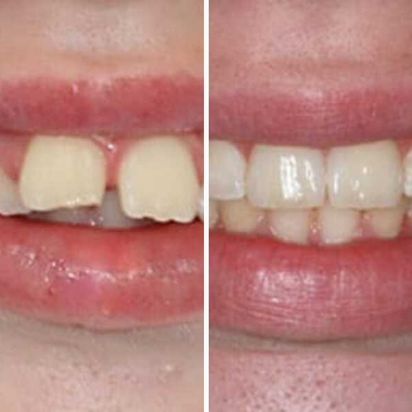 Pediatric orthodontic correction - Case 3