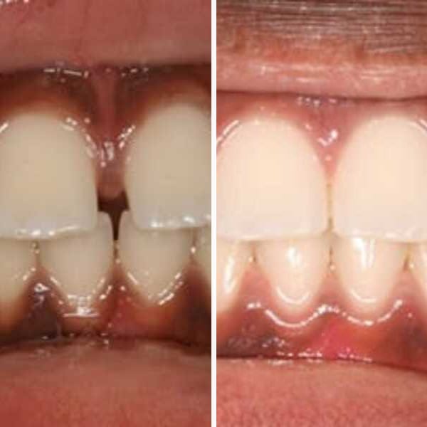 Pediatric orthodontic correction - Case 4