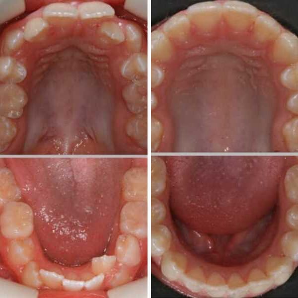 Pediatric orthodontic correction - Case 5