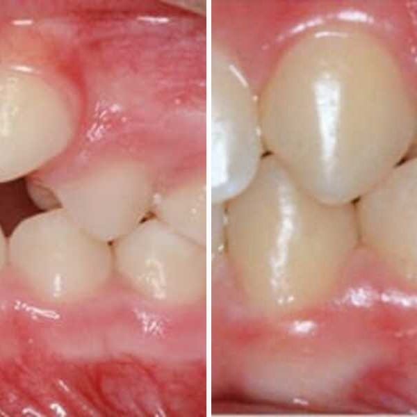 Pediatric orthodontic correction - Case 6