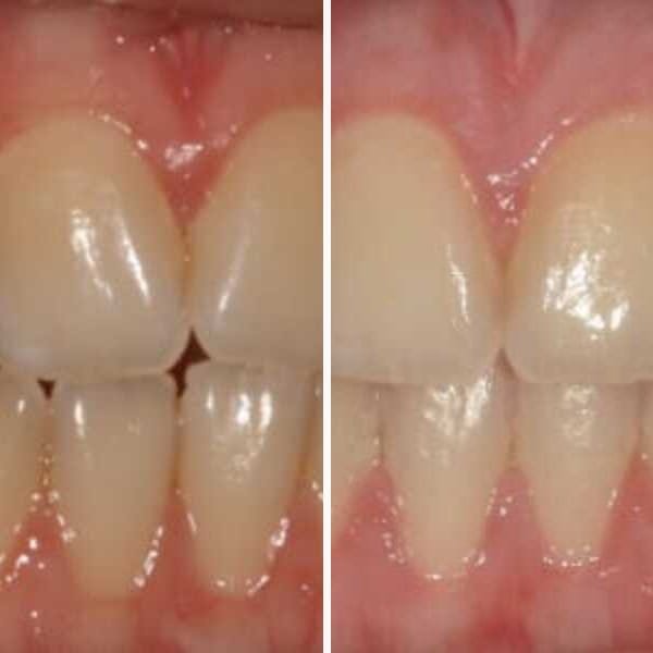 Pediatric orthodontic correction - Case 7