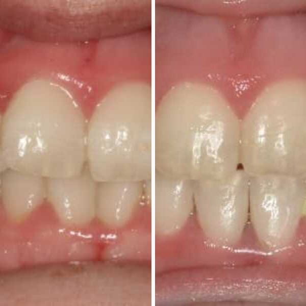 Adult orthodontic treatment with TMJ symptoms - Case 1
