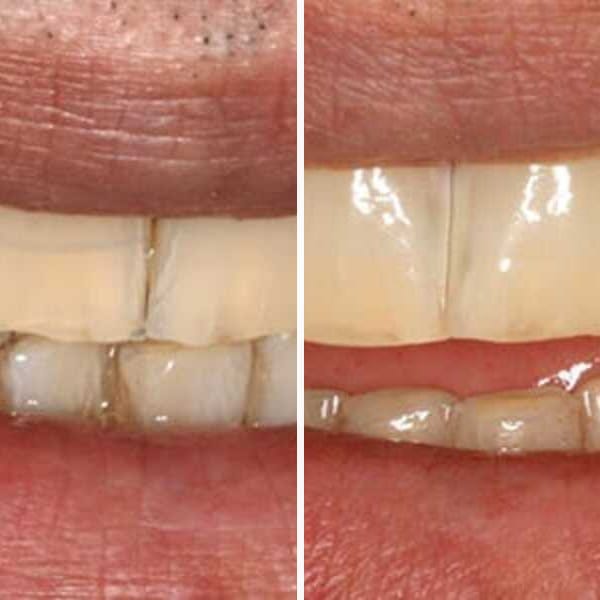 Invisalign treatment - Case 3