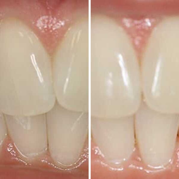 Invisalign treatment - Case 4
