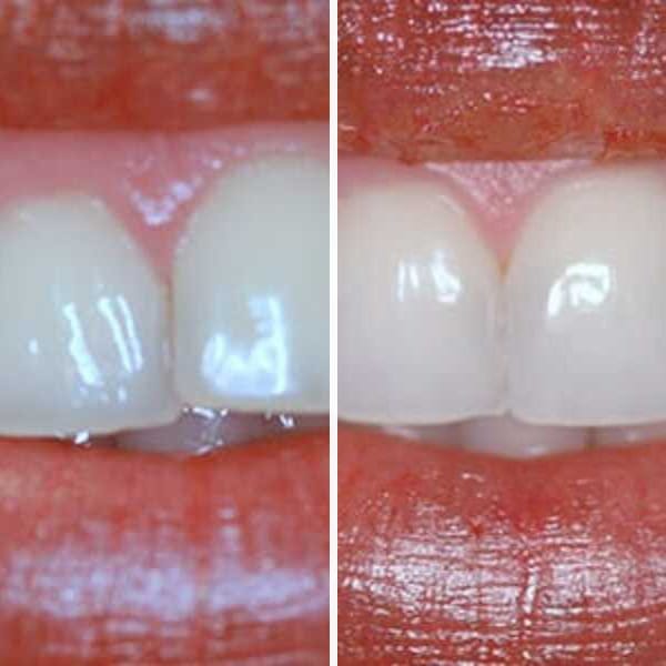 Invisalign treatment - Case 5