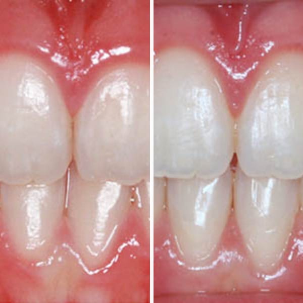 Pediatric orthodontic correction - Case 8