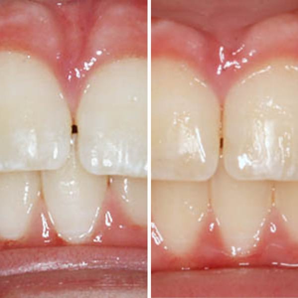 Pediatric orthodontic correction - Case 9