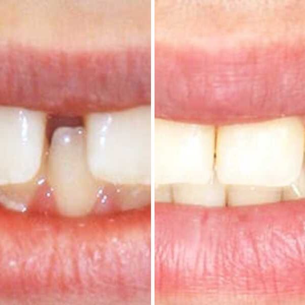 Pediatric orthodontic correction - Case 10