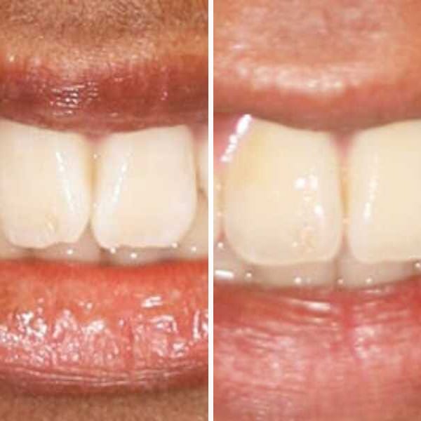 Pediatric orthodontic correction - Case 11