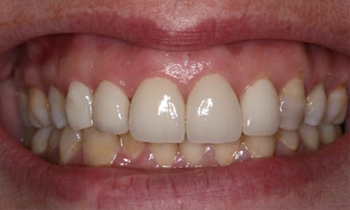Before and after veneers case After