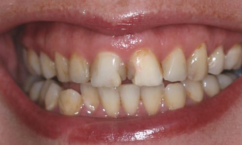 Before and after veneers case Before