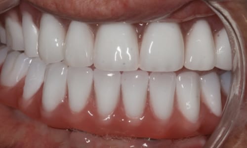 Before and after dentures case After