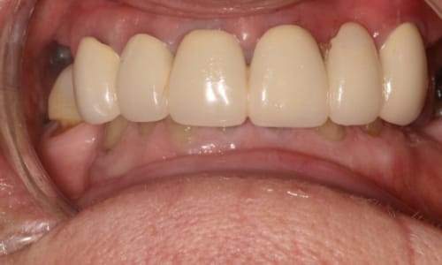 Before and after dentures case Before