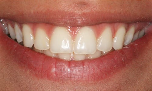 Before and after orthodontic case After