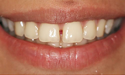 Before and after orthodontic case Before