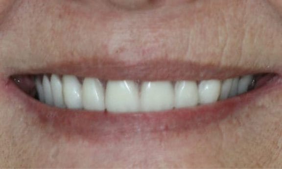 Implant-supported denture case After
