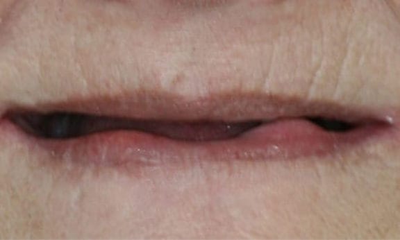 Implant-supported denture case Before