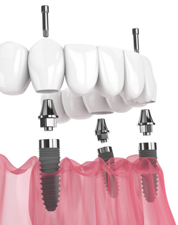 Full arch implant model