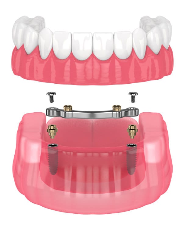 Implant-supported denture rendering