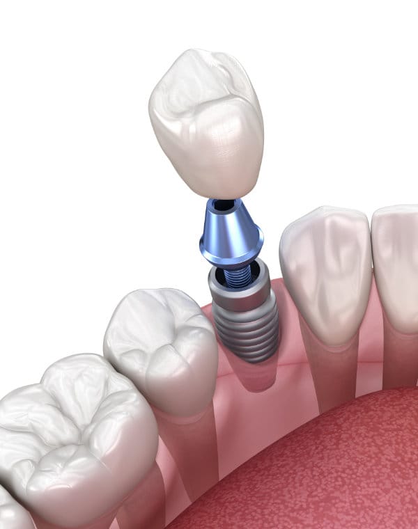 Single tooth implant model