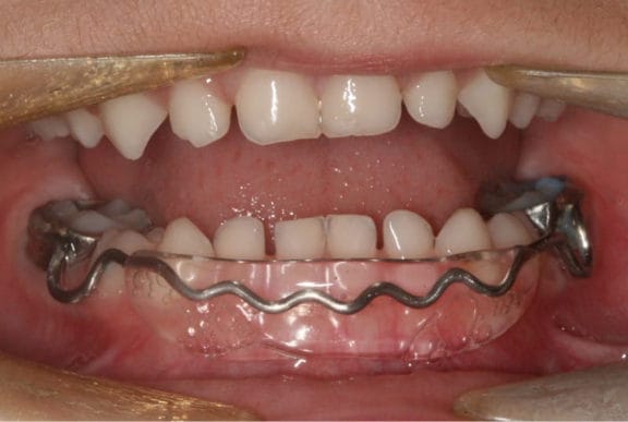 Lip bumper appliance for lip-sucking habit