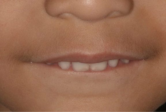 Lip sucking causing increased overjet
