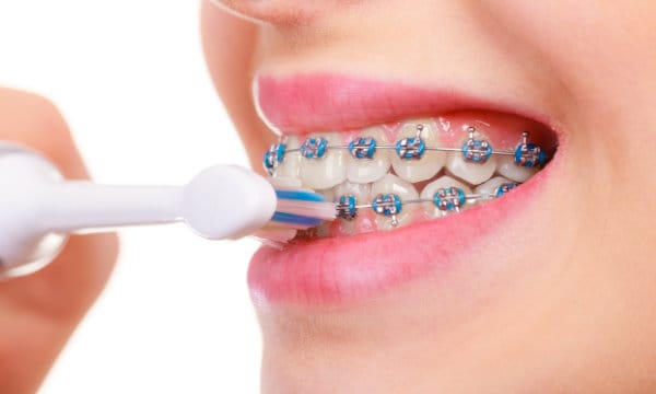 Orthodontic care tips for braces