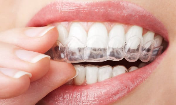 Clear Invisalign aligners
