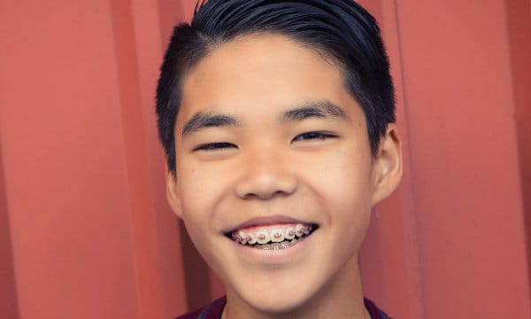 Conventional orthodontic braces and appliances