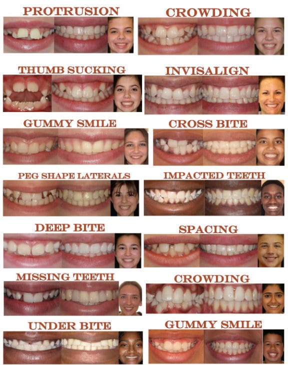 Patients of Azari and Zahedi Dentistry before and after orthodontic treatment