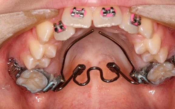 Custom palatal expander to widen the upper arch