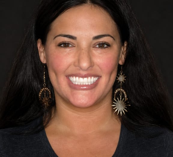 Before and after dental smile transformations