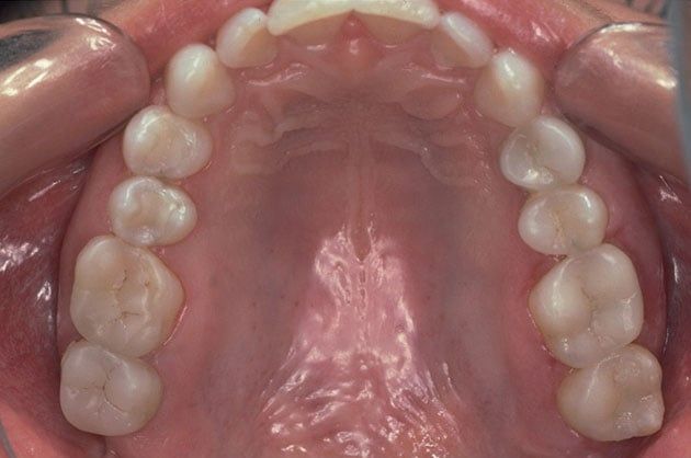 Tooth-colored composite filling before and after After